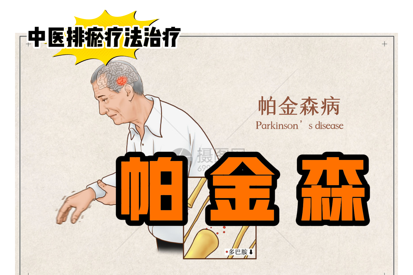 排瘀疗法治疗“帕金森”-中医排瘀疗法