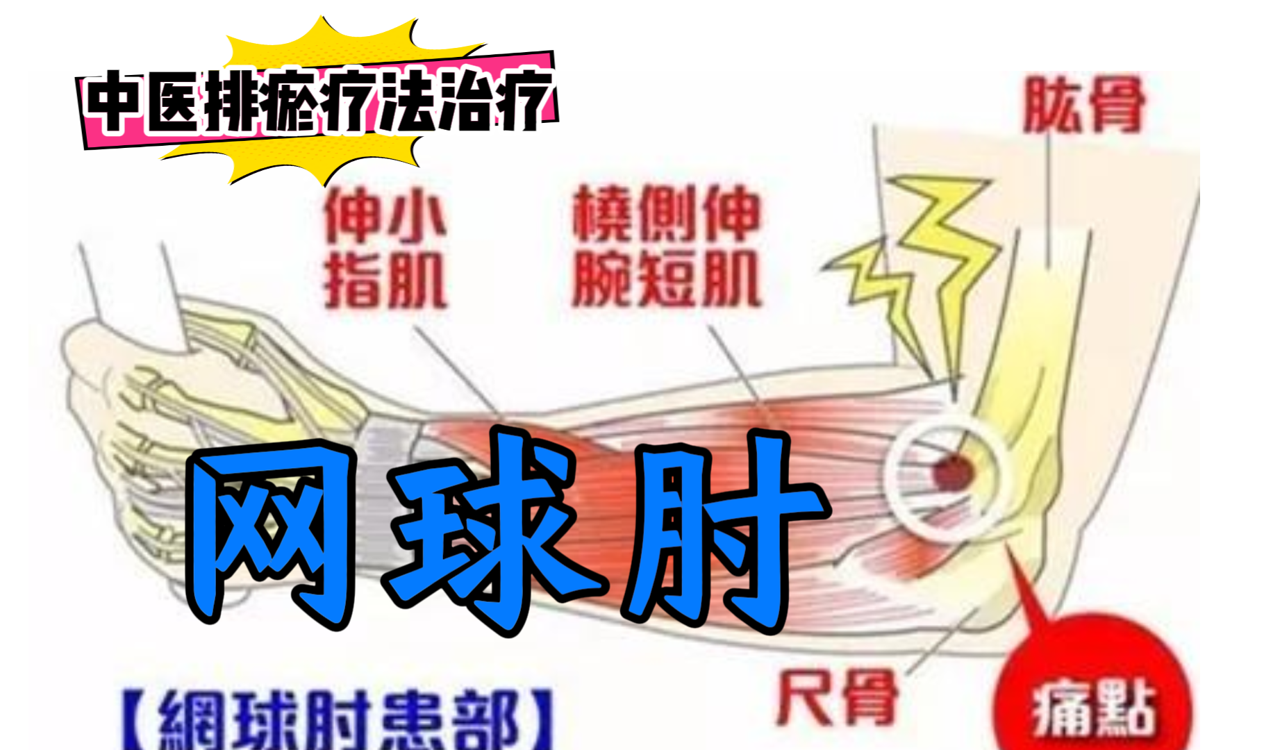 排瘀疗法治疗“网球肘”-中医排瘀疗法