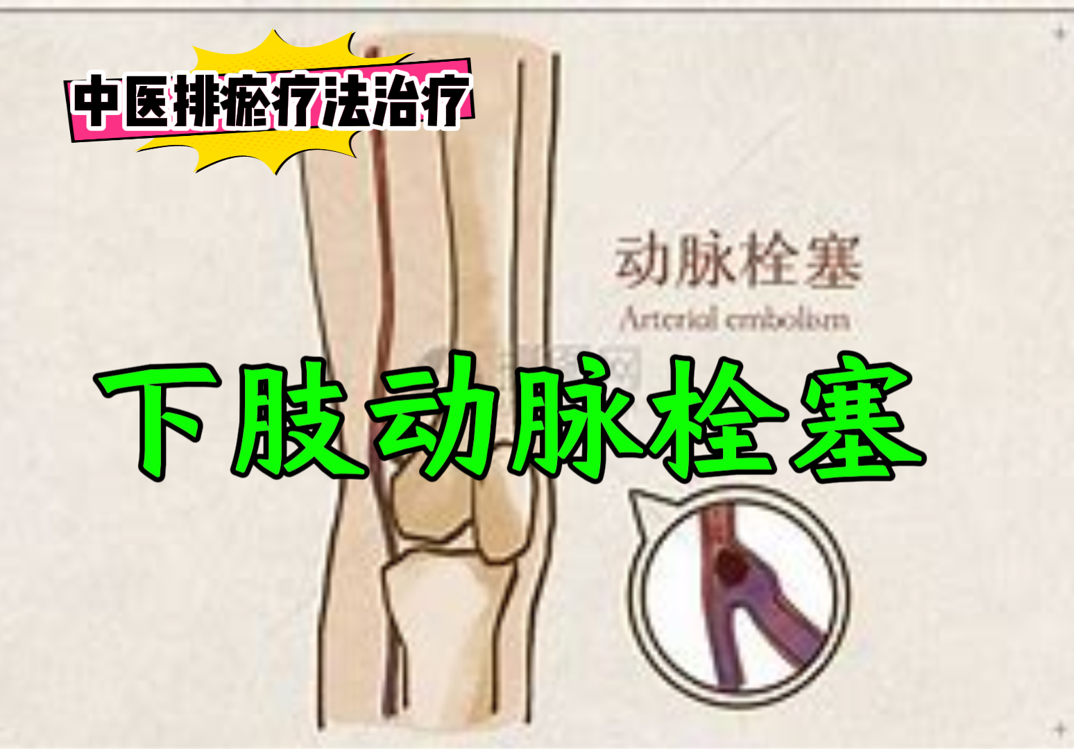 排瘀疗法治疗“下肢动脉栓塞”-中医排瘀疗法