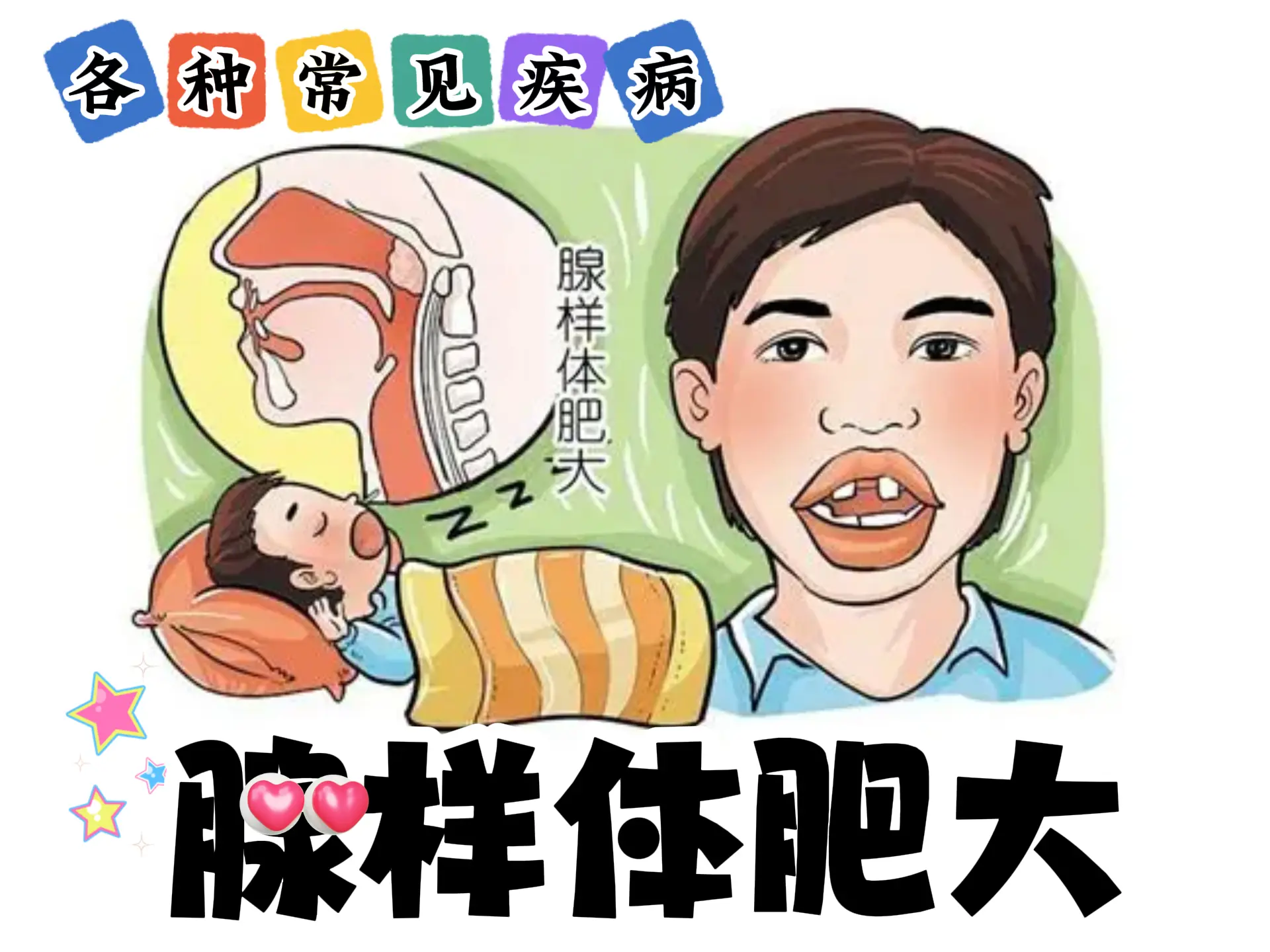 排瘀疗法治疗“腺样体肥大”-中医排瘀疗法