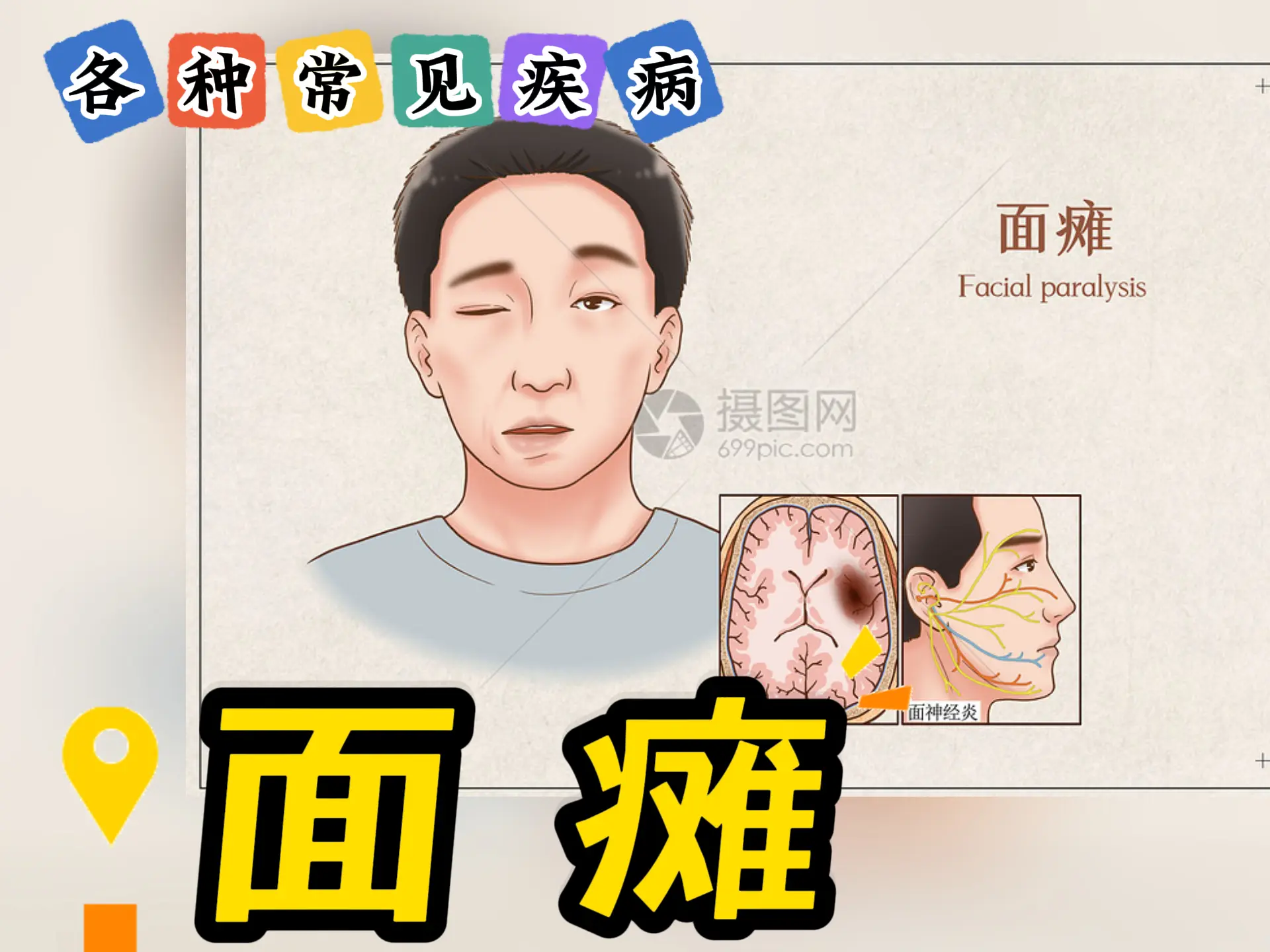 排瘀疗法治疗“面瘫”-中医排瘀疗法