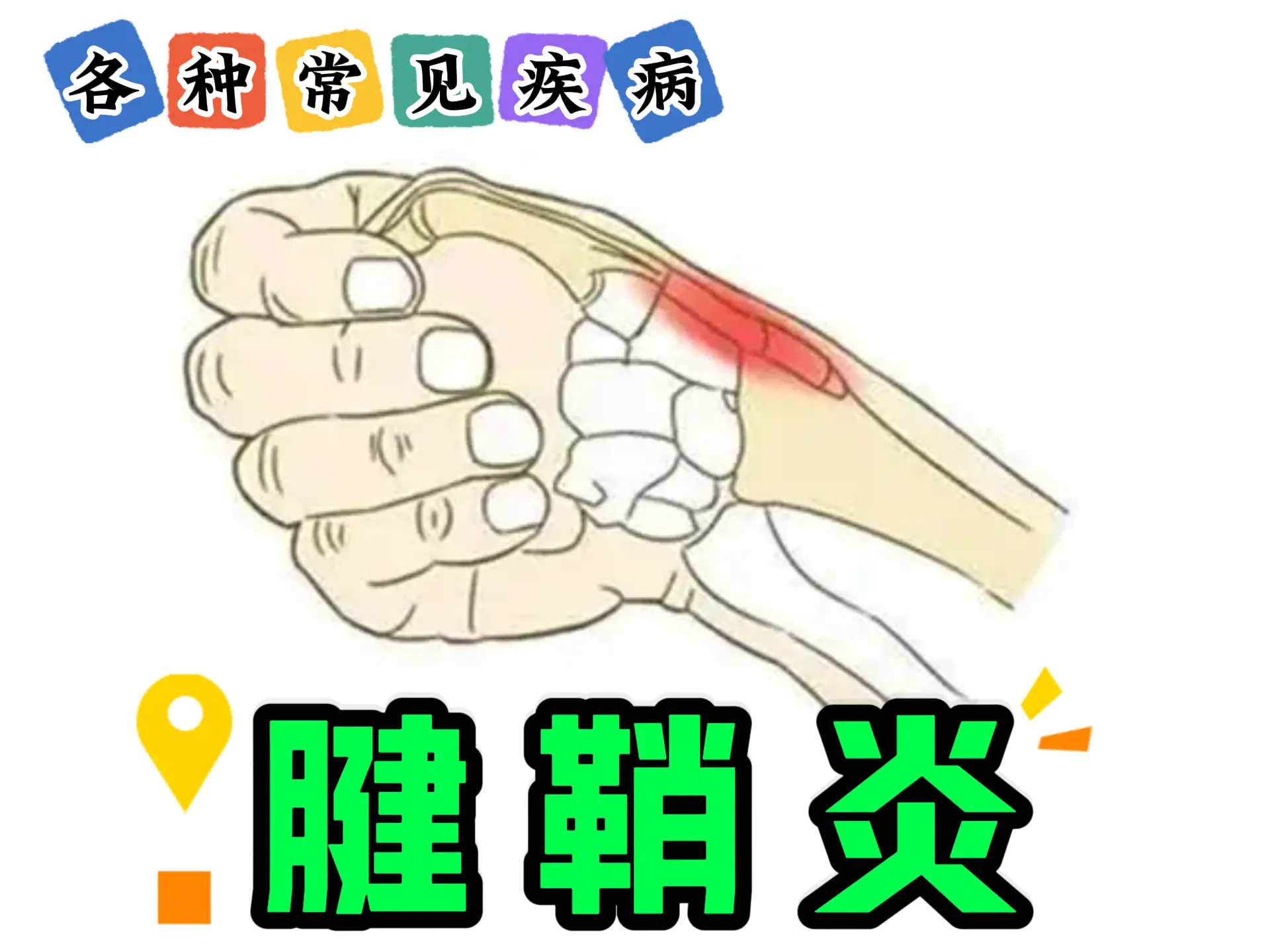排瘀疗法治疗“腱鞘炎”-中医排瘀疗法