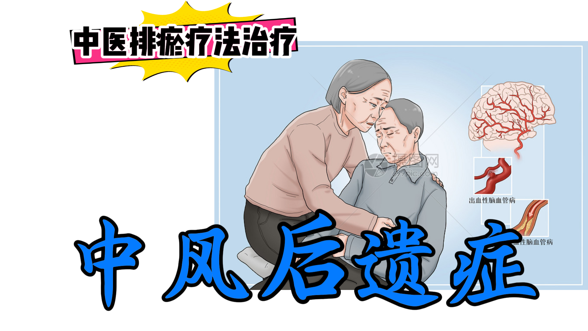 排瘀疗法治疗【中风后遗症】-中医排瘀疗法
