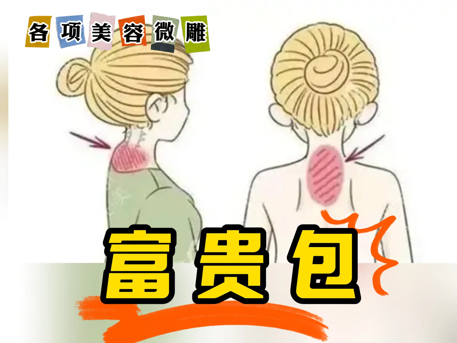 美容微雕排瘀【富贵包】-中医排瘀疗法