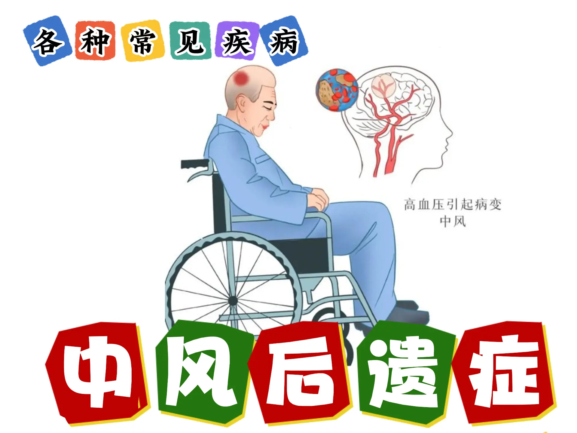 排瘀疗法治疗【中风后遗症】-中医排瘀疗法