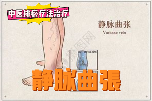排瘀疗法治疗“静脉曲张”-中医排瘀疗法