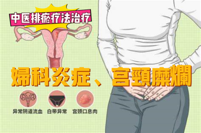 排瘀疗法治疗“妇科炎症、宫颈糜烂”-中医排瘀疗法