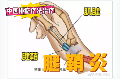 排瘀疗法治疗“腱鞘炎”-中医排瘀疗法
