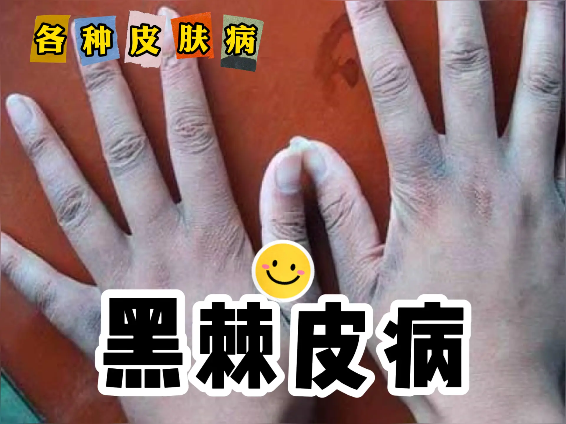 中医排瘀疗法治疗“黑棘皮病”-中医排瘀疗法