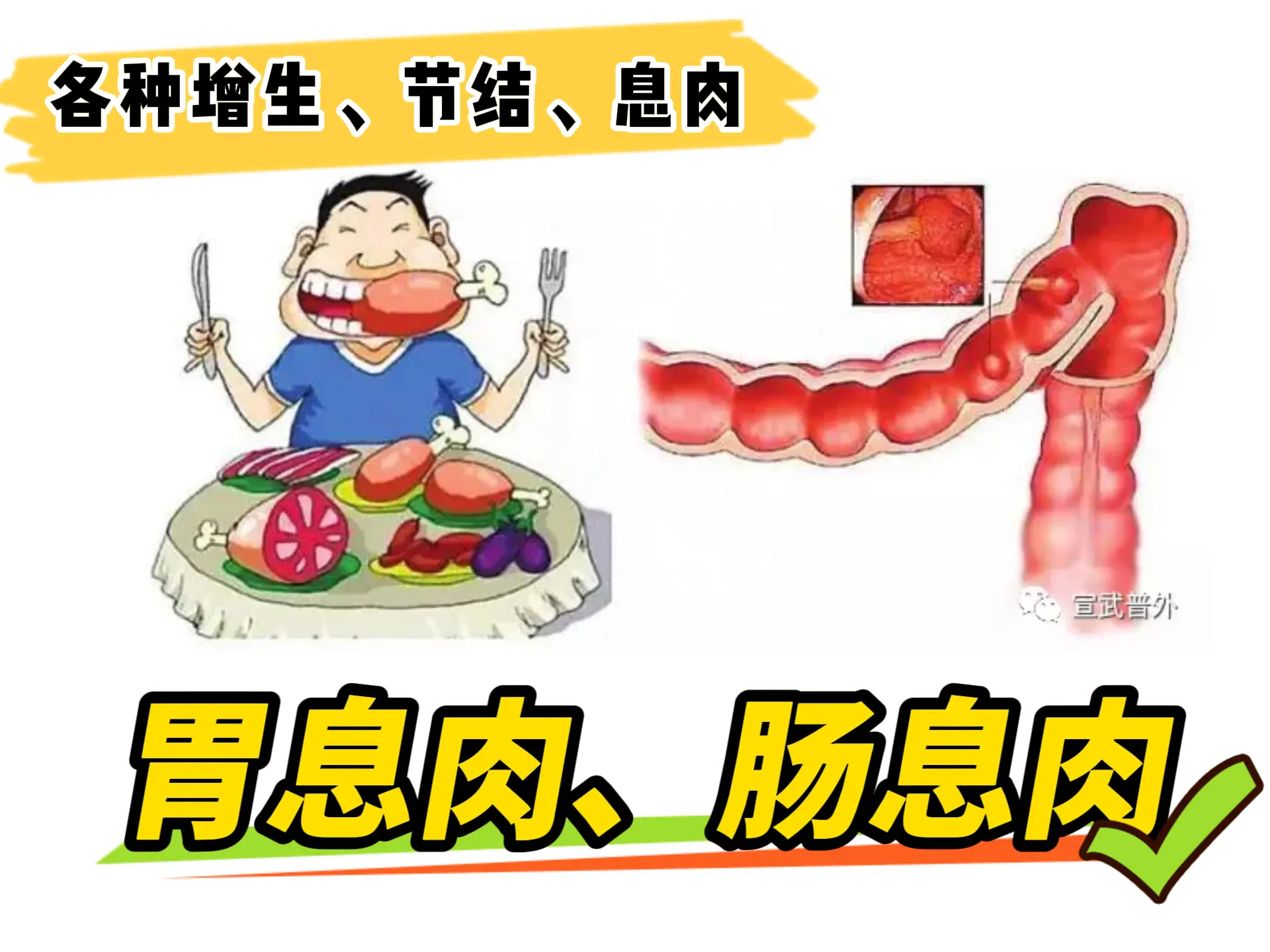 排瘀疗法治疗“胃息肉、肠息肉”-中医排瘀疗法