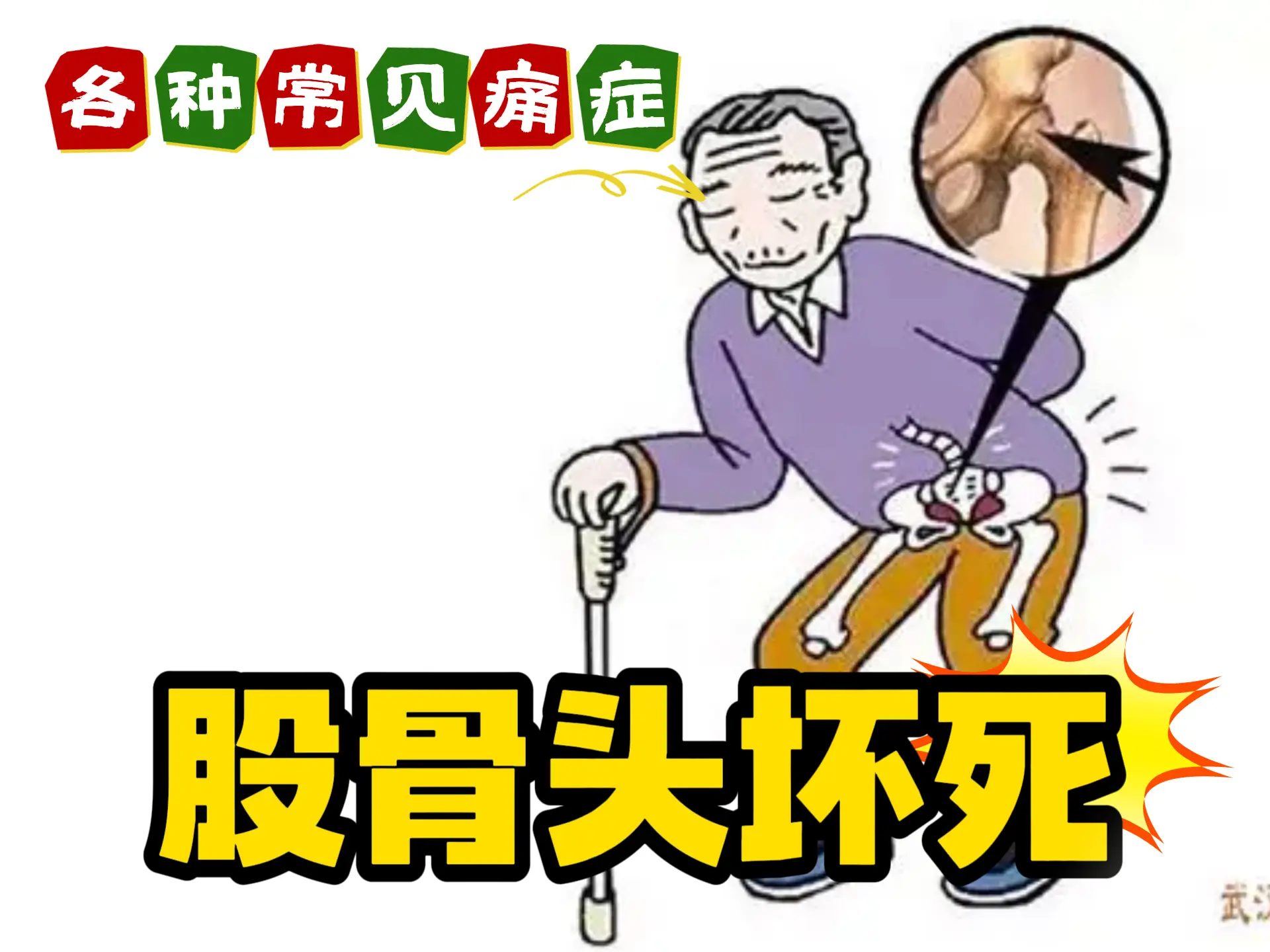 排瘀疗法治疗【股骨头坏死】-中医排瘀疗法