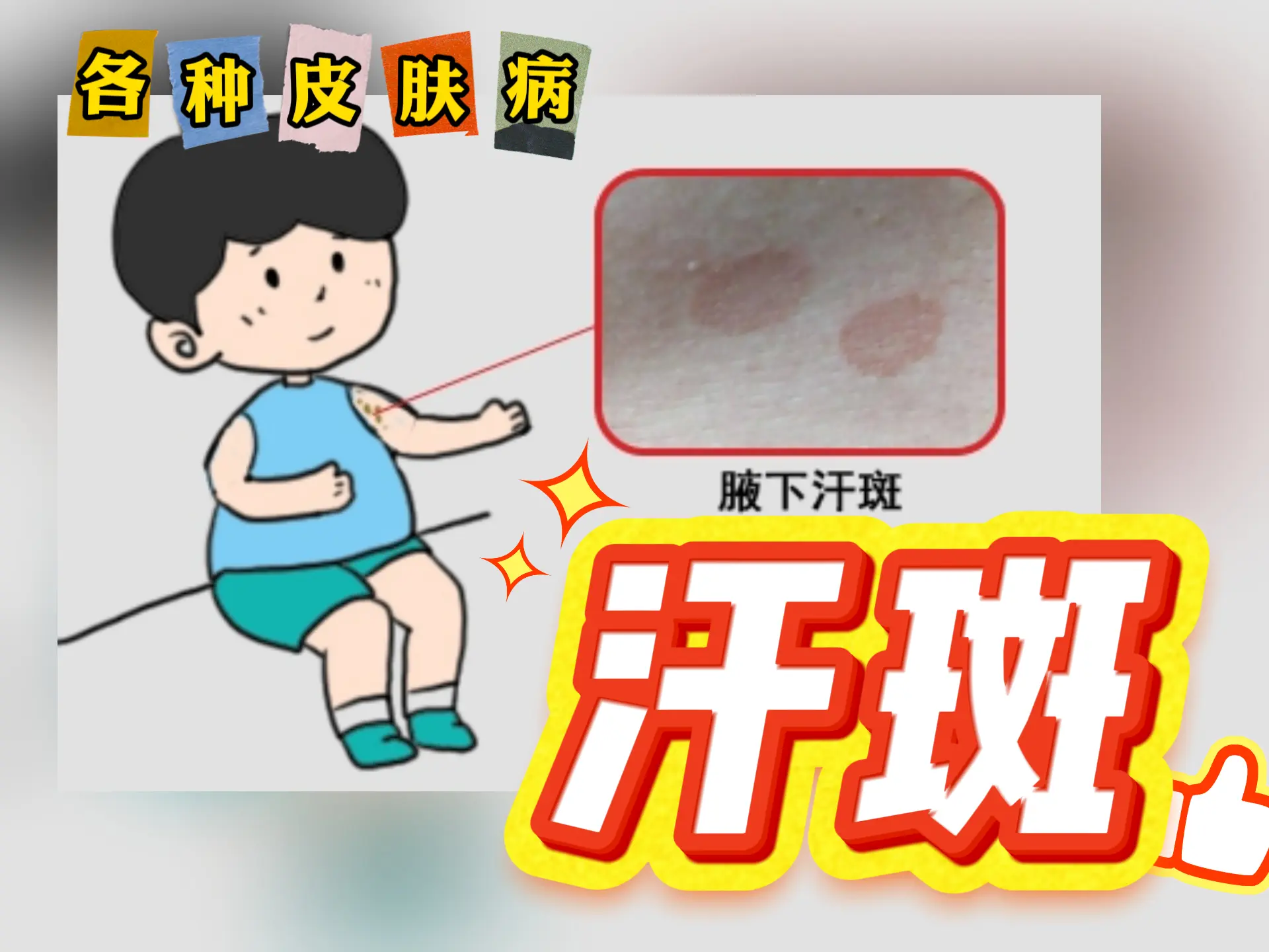 中医排瘀疗法治疗“汗斑”-中医排瘀疗法