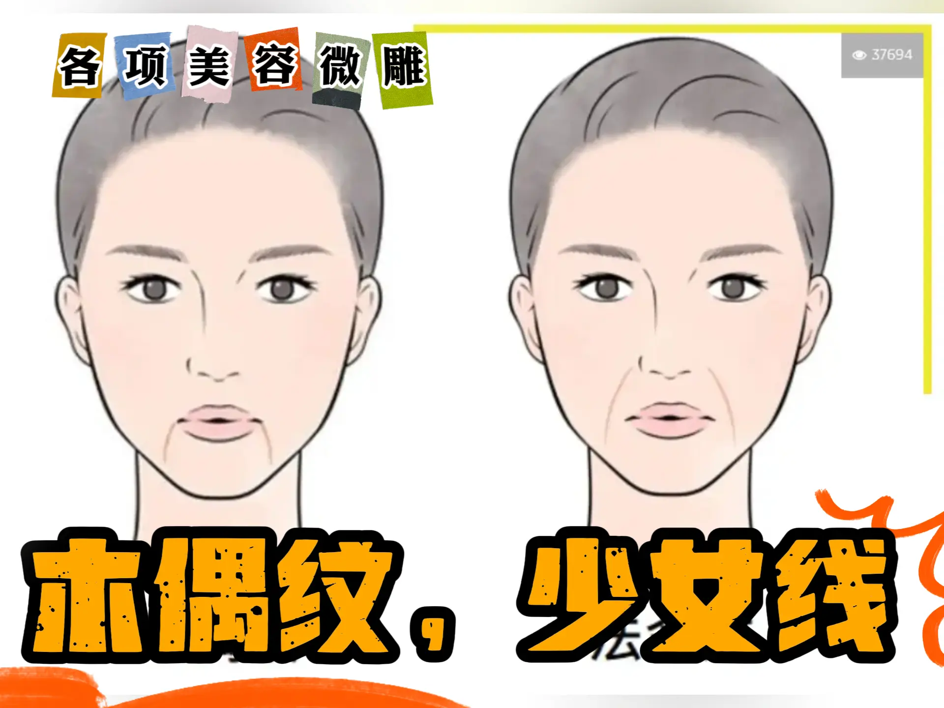 美容微雕排瘀 - 木偶纹，少女线-中医排瘀疗法