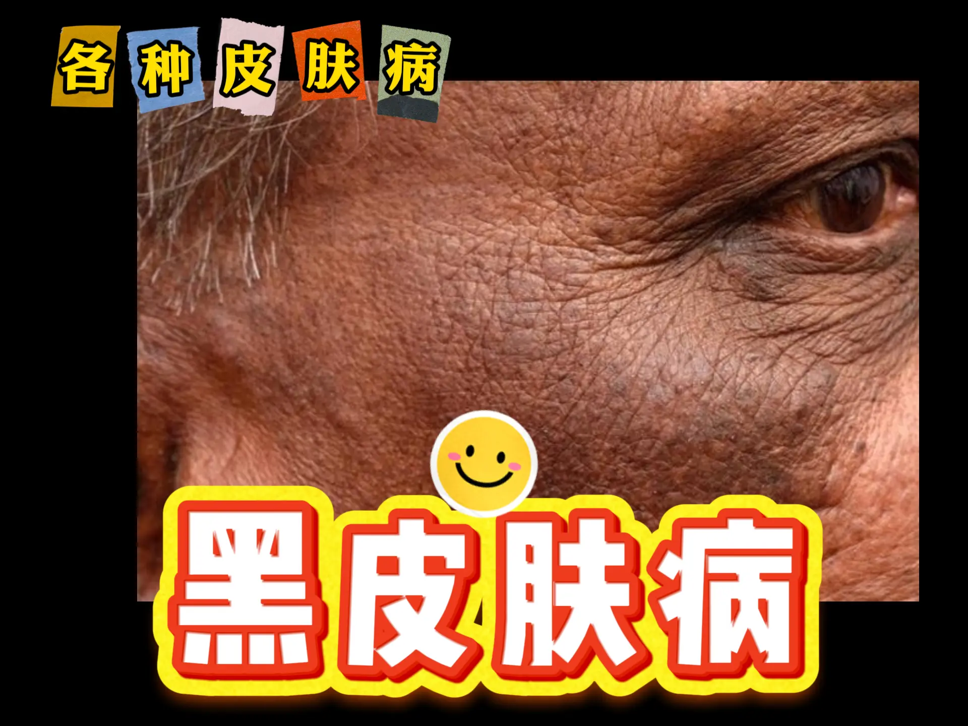 中医排瘀疗法治疗“黑皮肤病”-中医排瘀疗法