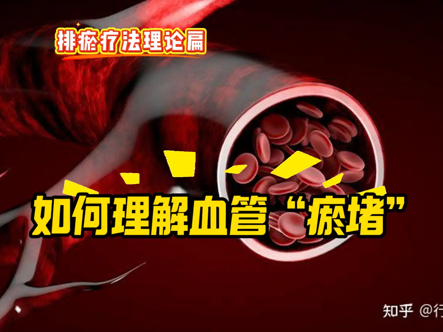 4 如何理解血管瘀堵-中医排瘀疗法