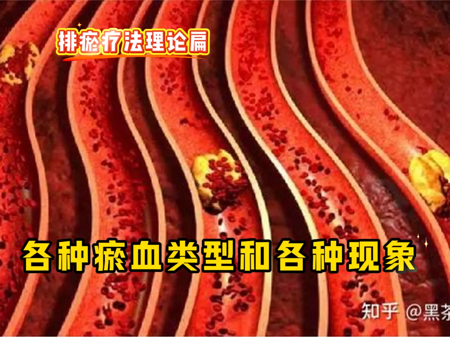 5 各种瘀血类型和各种现象-中医排瘀疗法