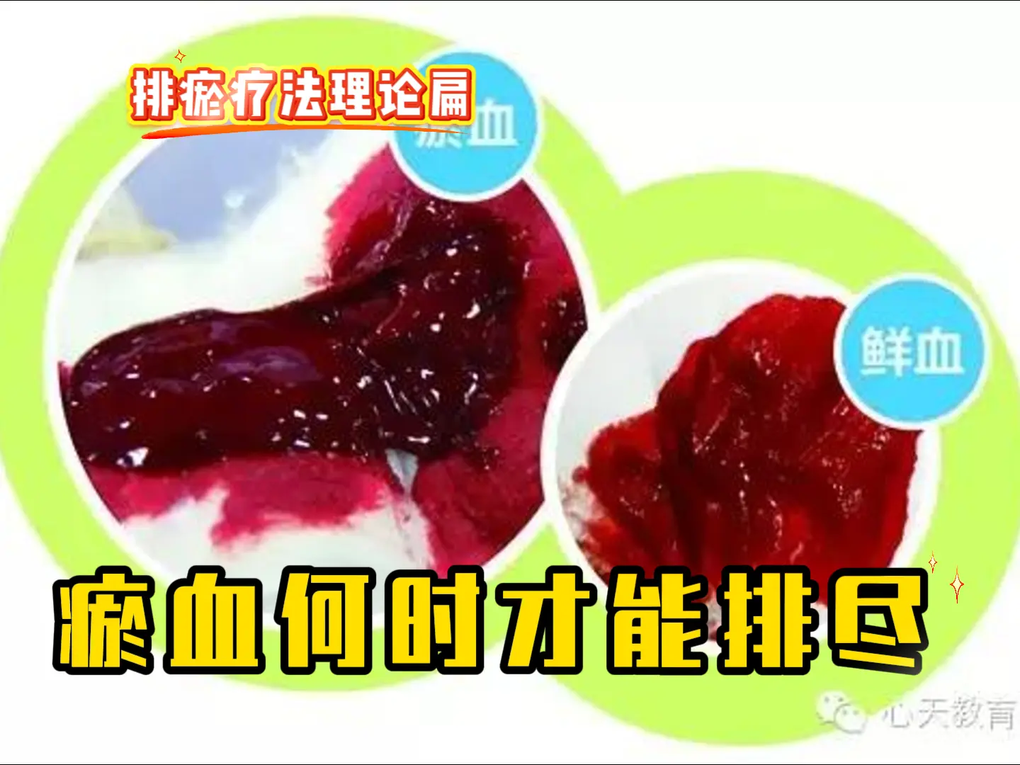 6 瘀血何时才能排尽-中医排瘀疗法