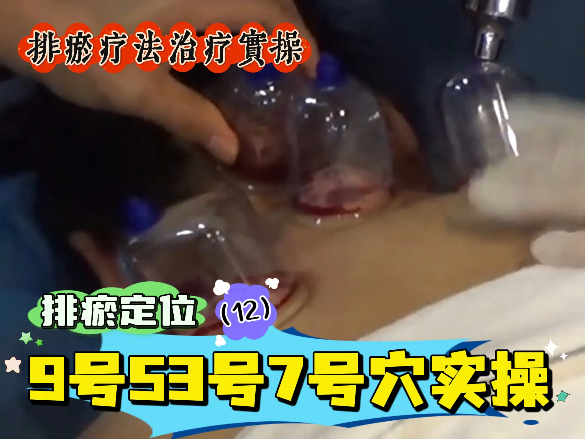 排瘀定位（12）9号53号7号穴实操-中医排瘀疗法