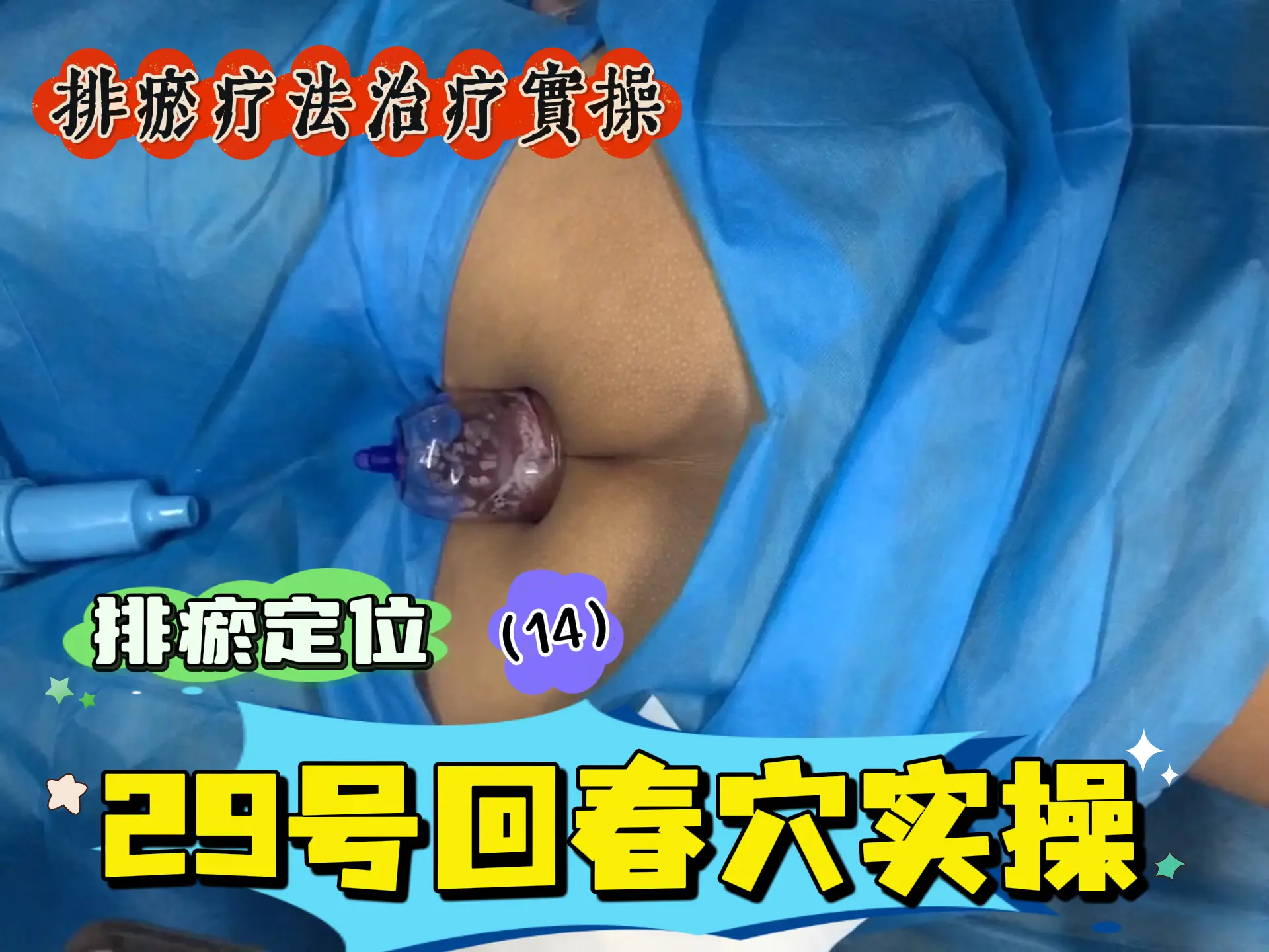 排瘀定位（14）29号回春穴实操-中医排瘀疗法