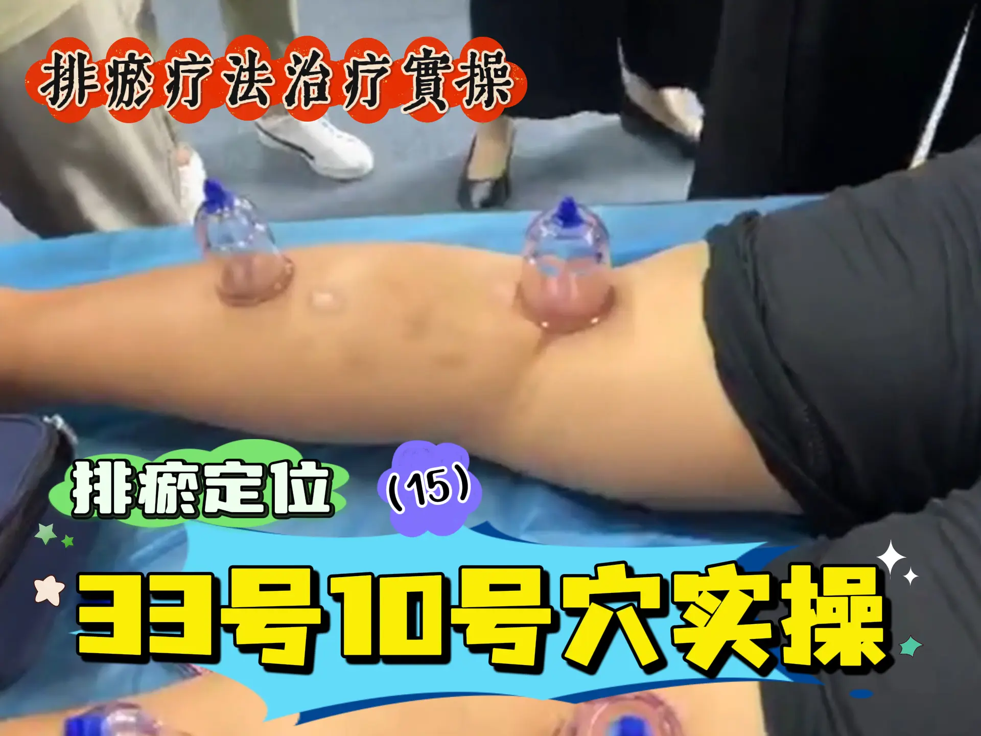 排瘀定位（15）33号10号穴实操-中医排瘀疗法