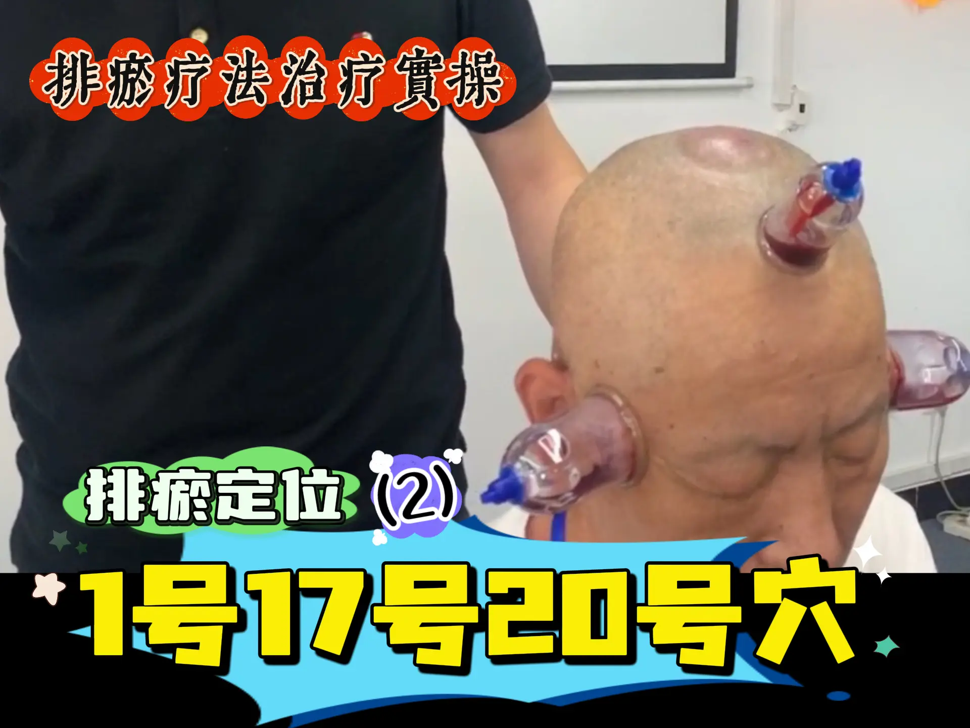 排瘀定位（2）1号17号20号穴实操-中医排瘀疗法