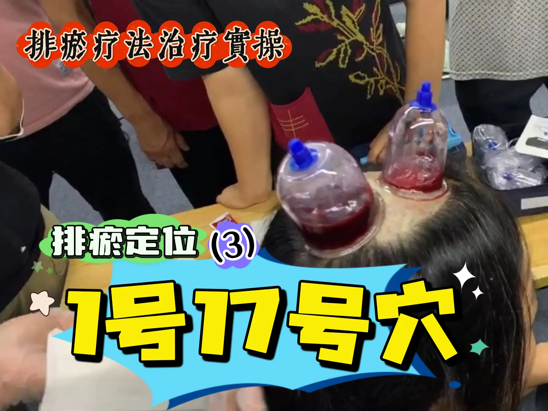 排瘀定位（3）1号17号穴实操-中医排瘀疗法