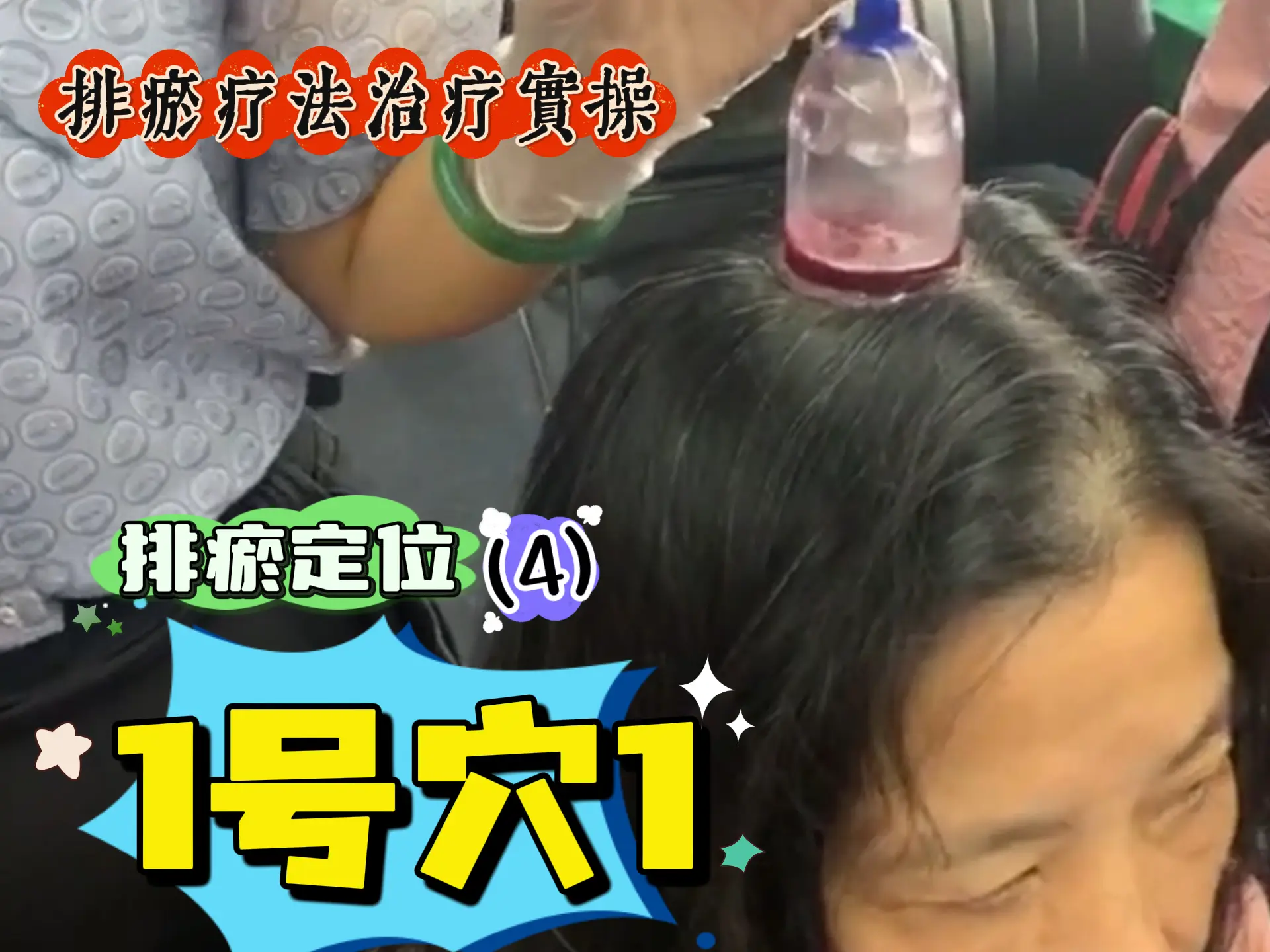 排瘀定位（4）1号穴实操-中医排瘀疗法