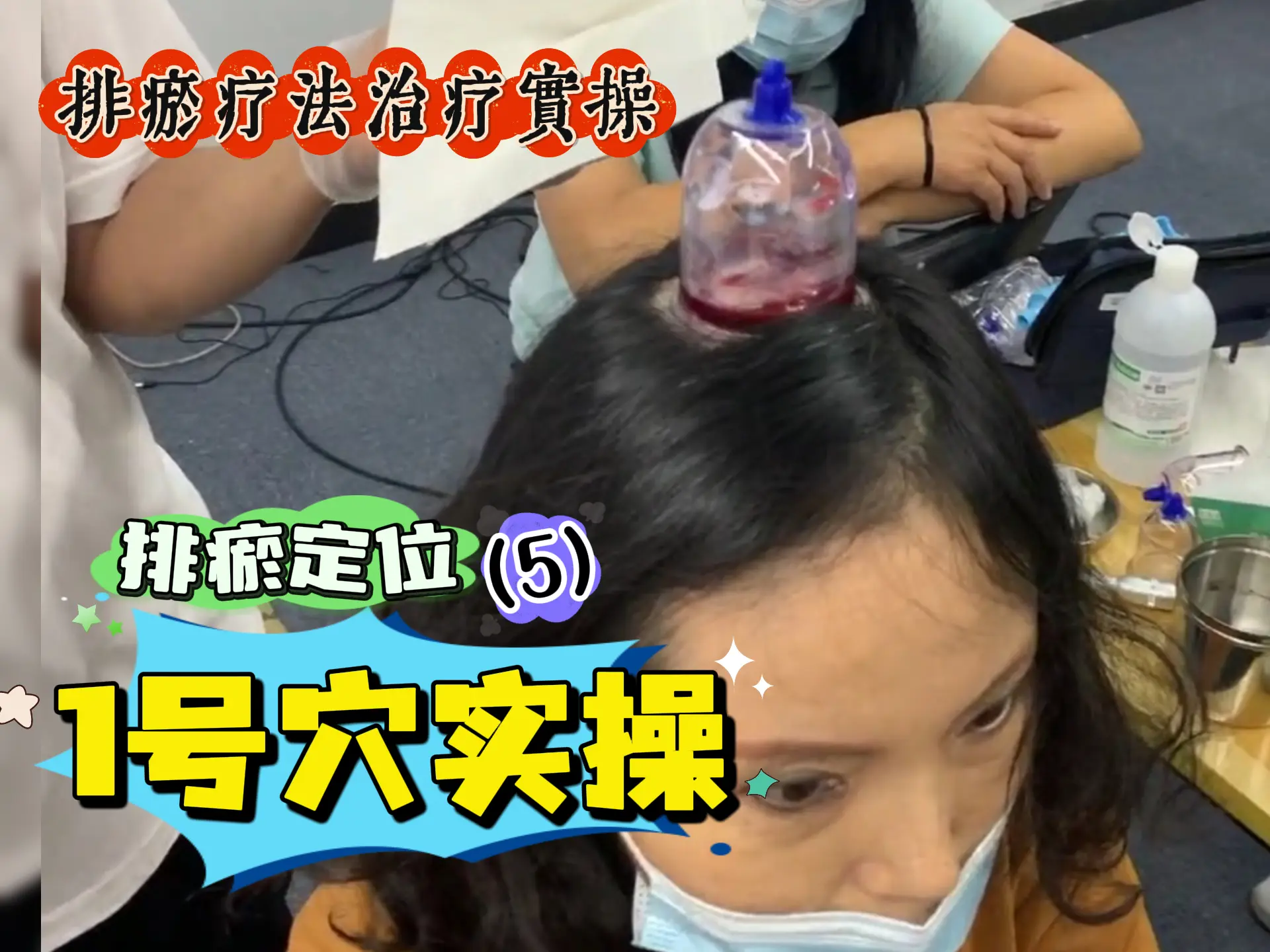 排瘀定位（5）1号穴实操-中医排瘀疗法