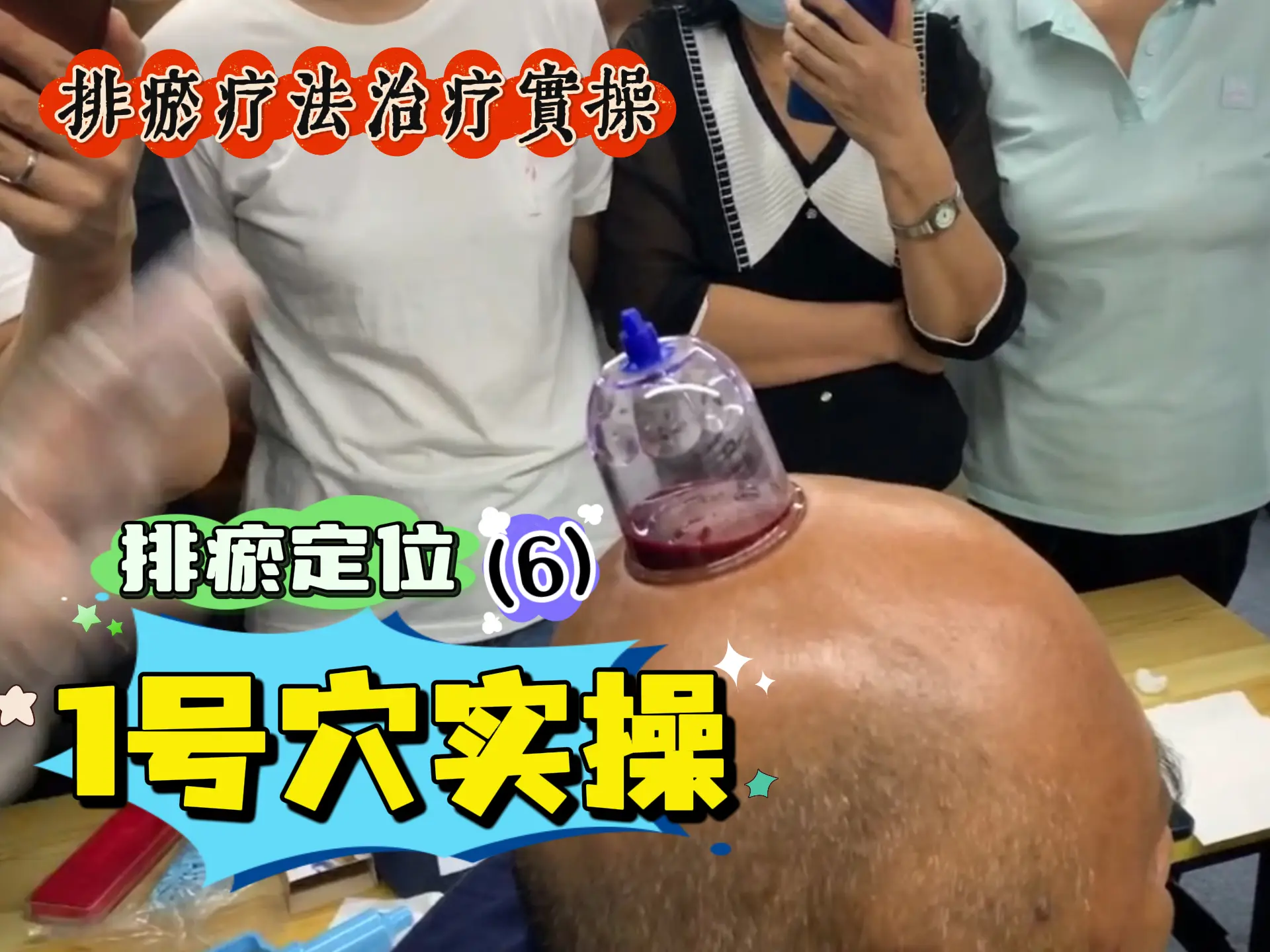 排瘀定位（6）1号穴实操-中医排瘀疗法