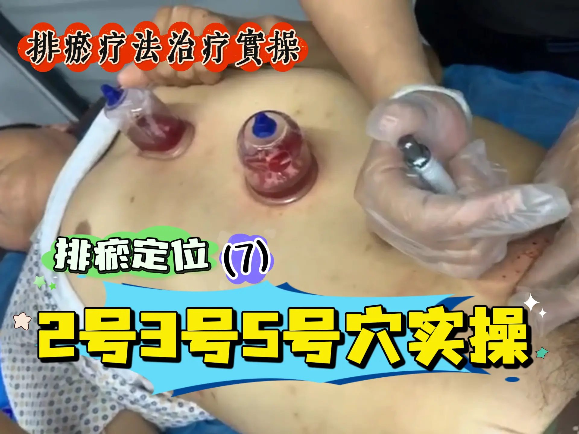 排瘀定位（7）2号3号5号穴实操-中医排瘀疗法