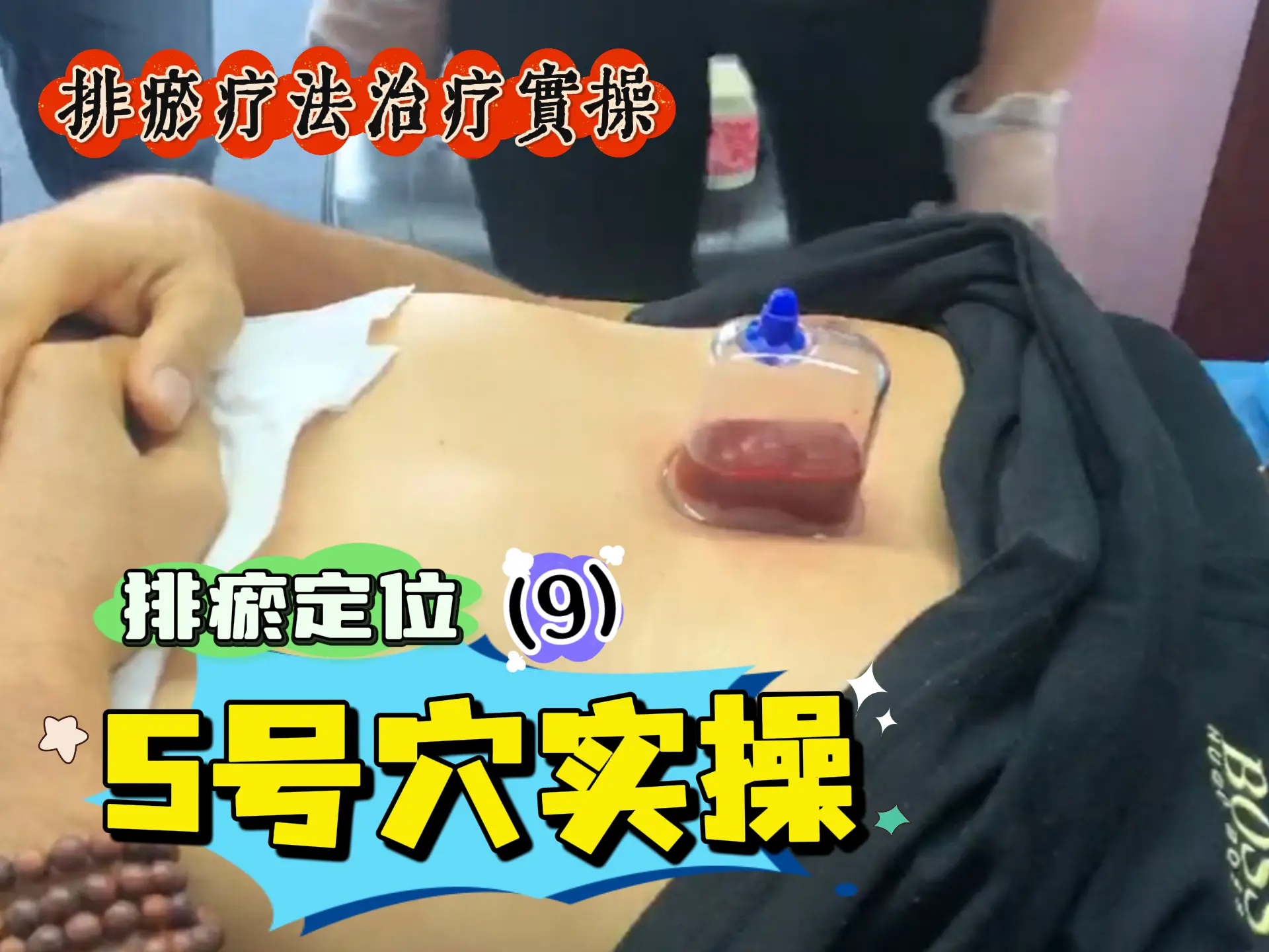 排瘀定位（9）5号穴实操-中医排瘀疗法