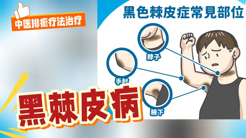 中医排瘀疗法治疗“黑棘皮病”-中医排瘀疗法