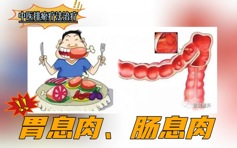 排瘀疗法治疗“胃息肉、肠息肉”-中医排瘀疗法