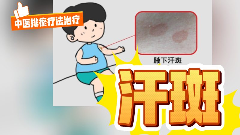 中医排瘀疗法治疗“汗斑”-中医排瘀疗法
